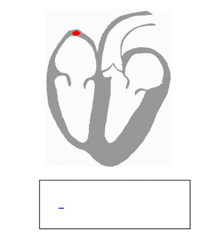 Animation der Erregungsausbreitung durch das schlagende Herz - dazu: Verlauf einer normalen EKG-Kurve