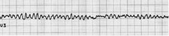 EKG-Aufzeichnung während eines Kammerflimmerns: Eine dichte Reihe vieler kleiner Zacken.